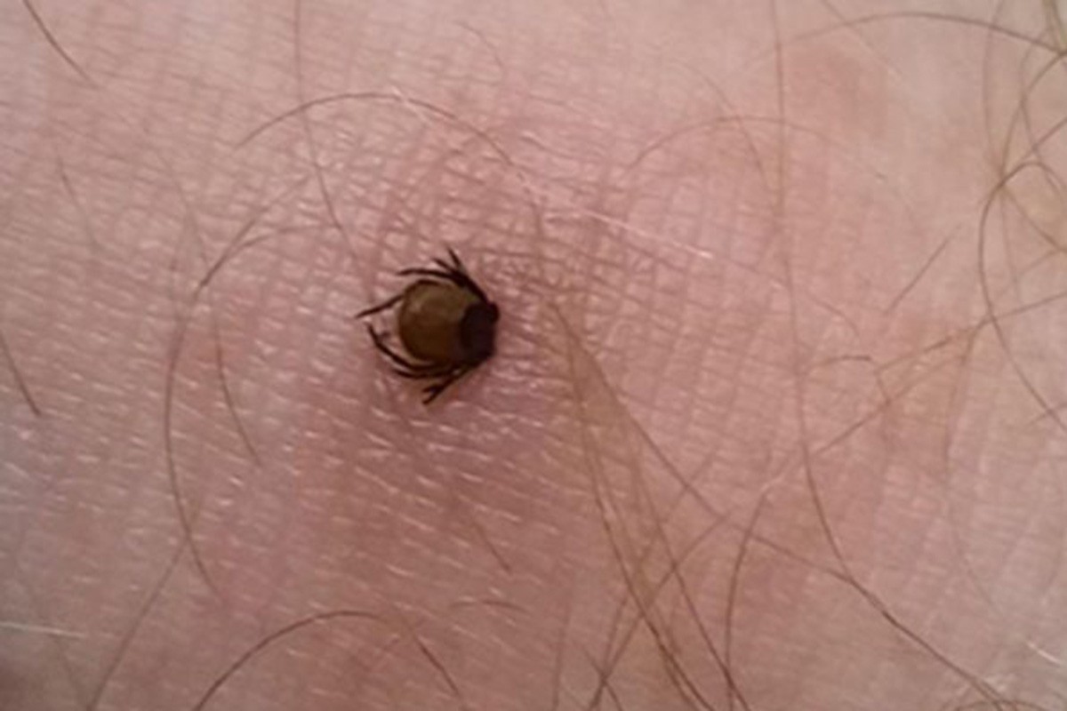 В Ганцевичском районе десятки взрослых и детей пострадали от клещей