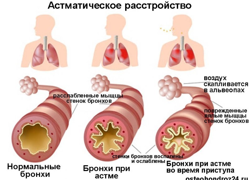 Фото с сайта osteohondroz24.ru, носит иллюстративный характер