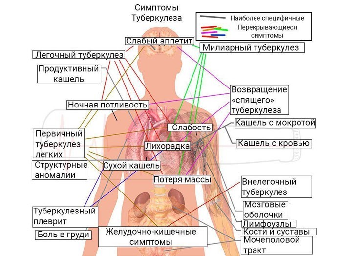 Симптомы туберкулёза